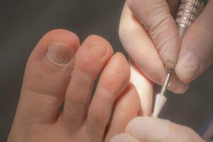 onicomicosis-tratamiento